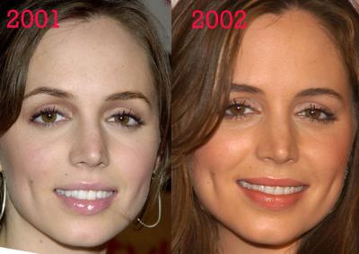 esthetique-lifting-visage-lift-acide-hyaluronique esthetique-lifting-visage-lift-acide-hyaluronique
