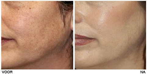 esthetique-peeling-moyen peeling moyen avant apres