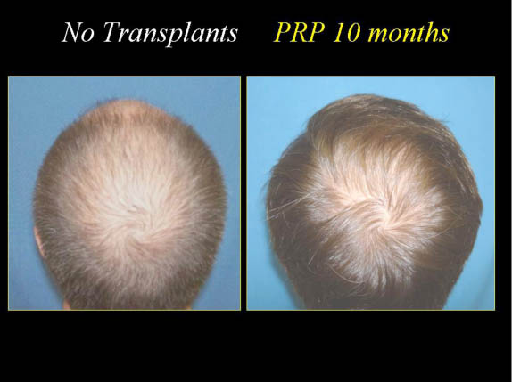 esthetique-prp-cheveu-resultat2 esthetique-prp-cheveu-resultat2