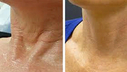 esthetique-prp-resultat esthetique-prp-resultat