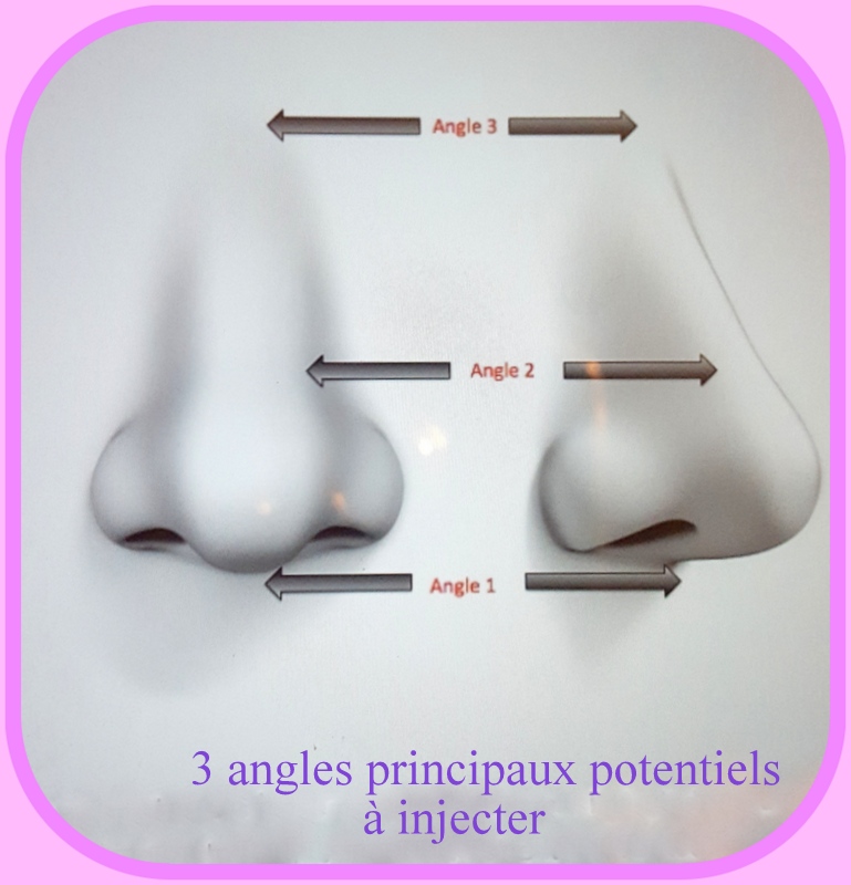 rhinoplastie 3 angles du nez